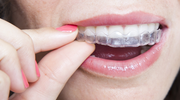 Michael-Riordan-Orthodontics-closeup-of-clear-aligners