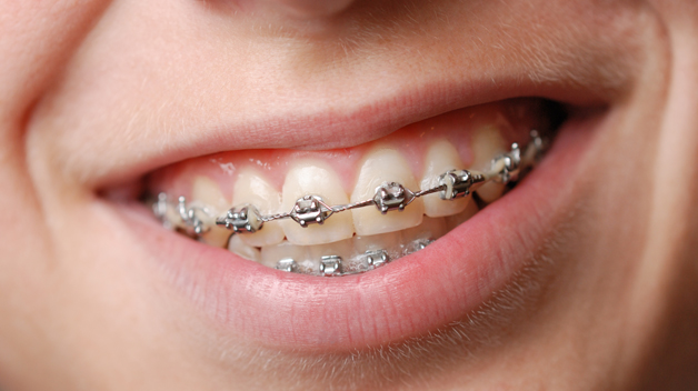 Michael-Riordan-Orthodontics-closeup-of-silver-braces